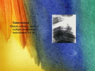 • Tuberculoma 
Nódulo solitario, único o 
múltiple de aspecto 
redondeado 3-6 cm 
 