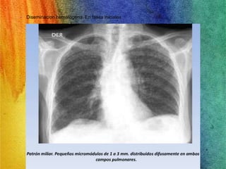 • Diseminacion hematogena. En fases iniciales 
 