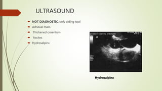ULTRASOUND
 NOT DIAGNOSTIC, only aiding tool
 Adnexal mass
 Thickened omentum
 Ascites
 Hydrosalpinx
Hydrosalpinx
 