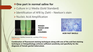 One part in normal saline for
 Culture in LJ Media (Gold Standard)
 Identification of AFB by Ziehl – Neelson’s stain
 Nucleic Acid Amplification
Agarwal et al / BioMed Central Ltd., courtesy of the Biology
Image Library
Combination of fluorescent staining techniques along with one of the acid fast staining
techniques or histopathology achieves sufficient sensitivity and specificity for the
diagnosis of female genital tuberculosis
ROUGH
TOUGH AND
BUFF
COLONIES
ACID FAST BACILLI
 