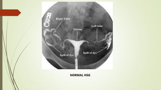 NORMAL HSG
 