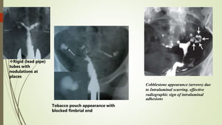 Rigid (lead pipe)
tubes with
nodulations at
places
Tobacco pouch appearance with
blocked fimbrial end
Cobblestone appearance (arrows) due
to Intraluminal scarring. effective
radiographic sign of intraluminal
adhesions
 