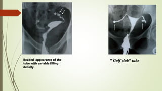 Beaded appearance of the
tube with variable filling
density
" Golf club" tube
 