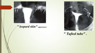 " leopard skin" appearance
" Tufted tube" .
 