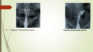  " T-shaped" tuberculosis uterus. Pseudo-unicornuate uterus.
 