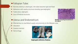 Fallopian Tube:
 Normal anatomy is destroyed , the tubes become rigid and fixed
 Adhesions with nearby structures develop (perisalpingitis)
 Tuberculous salpingitis
 Loss of fimbrial structures
Uterus and Endometrium
 Affected due to dual blood supply and proximity to the fallopian tube
 Ulceration
 Caseous necrosis
 Hemorrhage
Multiple Caseating Granulomas in
the salpinx
Salpingitis Isthmica Nodosa
 
