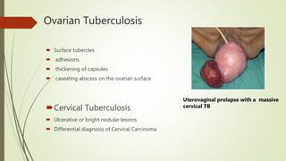 Ovarian Tuberculosis
 Surface tubercles
 adhesions
 thickening of capsules
 caseating abscess on the ovarian surface
Cervical Tuberculosis
 Ulcerative or bright nodular lesions
 Differential diagnosis of Cervical Carcinoma
Uterovaginal prolapse with a massive
cervical TB
 