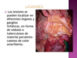 

Las lesiones se
pueden localizar en
diferentes órganos y
ganglios
linfáticos, en forma
de nódulos o
tuberculosos de
material porulentocaseoso de color
amarillento.

 