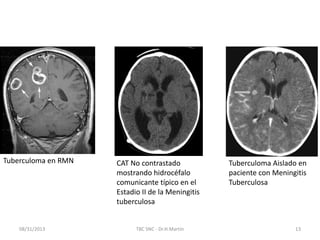 08/31/2013 TBC SNC - Dr.H.Martín 13
Tuberculoma Aislado en
paciente con Meningitis
Tuberculosa
CAT No contrastado
mostrando hidrocéfalo
comunicante típico en el
Estadio II de la Meningitis
tuberculosa
Tuberculoma en RMN
 