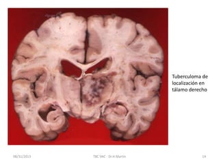 08/31/2013 TBC SNC - Dr.H.Martín 14
Tuberculoma de
localización en
tálamo derecho
 