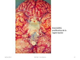 08/31/2013 TBC SNC - Dr.H.Martín 17
Aracnoiditis
proliferativa de la
región basilar
 