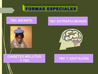 FORMAS ESPECIALES
TBC INFANTIL TBC EXTRAPULMONAR
DIABETES MELLITUS
Y TBC
TBC Y GESTACIÓN
 