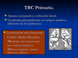 TBC Primaria.
   Aparece consecutiva a infección inicial.
   Localizada principalmente en campos medios e
    inferiores de los pulmones.

   Localización más frecuente:
    Lóbulo Medio Derecho:
    Rodeado más densamente

    por nodulos linfáticos.
    Mayor longitud y menor
    diámetro relativo.
 
