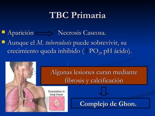 TBC Primaria
   Aparición          Necrosis Caseosa.
   Aunque el M. tuberculosis puede sobrevivir, su
    crecimiento queda inhibido ( PO2, pH ácido).


                   Algunas lesiones curan mediante
                       fibrosis y calcificación


                              Complejo de Ghon.
 