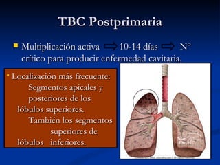 TBC Postprimaria
       Multiplicación activa      10-14 días     Nº
        crítico para producir enfermedad cavitaria.
   Localización más frecuente:
        Segmentos apicales y
        posteriores de los
     lóbulos superiores.
        También los segmentos
               superiores de
     lóbulos inferiores.
 