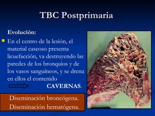 TBC Postprimaria
    Evolución:
   En el centro de la lesión, el
    material caseoso presenta
    licuefacción, va destruyendo las
    paredes de los bronquios y de
    los vasos sanguíneos, y se drena
    en ellos el contenido
                     CAVERNAS.
    Diseminación broncógena.
    Diseminación hematógena.
 