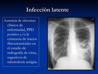 Infección latente
Ausencia de síntomas
  clínicos de
  enfermedad, PPD
  positivo y/o la
  existencia de tractos
  fibrocicatriciales en
  el estudio de
  radiografía de tórax,
  sugestivos de
  tuberculosis antigüa.
 