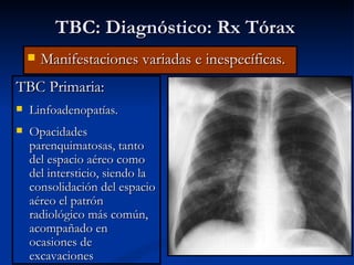 TBC: Diagnóstico: Rx Tórax
       Manifestaciones variadas e inespecíficas.
TBC Primaria:
   Linfoadenopatías.
   Opacidades
    parenquimatosas, tanto
    del espacio aéreo como
    del intersticio, siendo la
    consolidación del espacio
    aéreo el patrón
    radiológico más común,
    acompañado en
    ocasiones de
    excavaciones
 