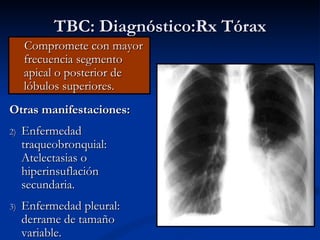 TBC: Diagnóstico:Rx Tórax
     Compromete con mayor
     frecuencia segmento
     apical o posterior de
     lóbulos superiores.
Otras manifestaciones:
2)   Enfermedad
     traqueobronquial:
     Atelectasias o
     hiperinsuflación
     secundaria.
3)   Enfermedad pleural:
     derrame de tamaño
     variable.
 