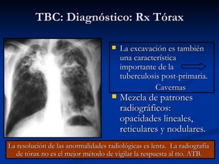 TBC: Diagnóstico: Rx Tórax

                                        La excavación es también
                                         una característica
                                         importante de la
                                         tuberculosis post-primaria.
                                                    Cavernas
                                        Mezcla de patrones
                                         radiográficos:
                                         opacidades lineales,
                                         reticulares y nodulares.
La resolución de las anormalidades radiológicas es lenta. La radiografía
   de tórax no es el mejor método de vigilar la respuesta al tto. ATB.
 