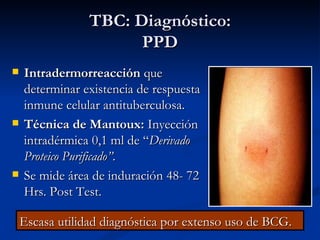 TBC: Diagnóstico:
                       PPD
   Intradermorreacción que
    determinar existencia de respuesta
    inmune celular antituberculosa.
   Técnica de Mantoux: Inyección
    intradérmica 0,1 ml de “Derivado
    Proteico Purificado”.
   Se mide área de induración 48- 72
    Hrs. Post Test.

    Escasa utilidad diagnóstica por extenso uso de BCG.
 
