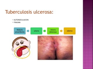Tuberculosis ulcerosa:
 