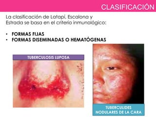 CLASIFICACIÓN
La clasificación de Latapí, Escalona y
Estrada se basa en el criterio inmunológico:

• FORMAS FIJAS
• FORMAS DISEMINADAS O HEMATÓGENAS


         TUBERCULOSIS LUPOSA




                                          TUBERCULIDES
                                       NODULARES DE LA CARA
 
