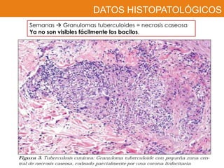 DATOS HISTOPATOLÓGICOS
Semanas  Granulomas tuberculoides = necrosis caseosa
Ya no son visibles fácilmente los bacilos.
 