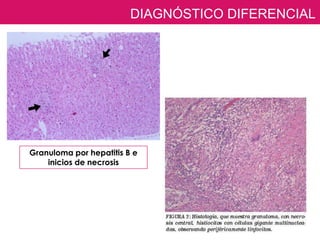 DIAGNÓSTICO DIFERENCIAL
                         DATOS HISTOPATOLÓGICOS




Granuloma por hepatitis B e
    inicios de necrosis
 