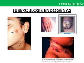EPIDEMIOLOGÍA

TUBERCULOSIS ENDOGENAS
 