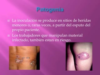    La inoculación se produce en sitios de heridas
    menores o, raras veces, a partir del esputo del
    propio paciente.
   Los trabajadores que manipulan material
    infectado, también estan en riesgo.
 