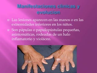    Las lesiones aparecen en las manos o en las
    extremidades inferiores en los niños.
   Son pápulas o papulopústulas pequeñas,
    asintomáticas, rodeadas de un halo
    inflamatorio y violáceo.
 