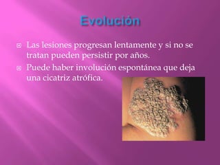    Las lesiones progresan lentamente y si no se
    tratan pueden persistir por años.
   Puede haber involución espontánea que deja
    una cicatriz atrófica.
 