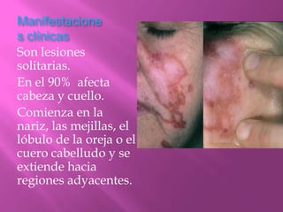 Manifestacione
s clínicas
Son lesiones
solitarias.
En el 90% afecta
cabeza y cuello.
Comienza en la
nariz, las mejillas, el
lóbulo de la oreja o el
cuero cabelludo y se
extiende hacia
regiones adyacentes.
 