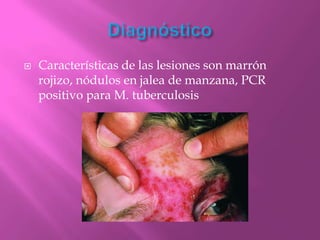    Características de las lesiones son marrón
    rojizo, nódulos en jalea de manzana, PCR
    positivo para M. tuberculosis
 