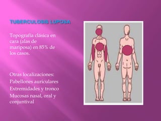 TUBERCULOSIS LUPOSA

Topografía clásica en
cara (alas de
mariposa) en 85% de
los casos.



Otras localizaciones:
Pabellones auriculares
Extremidades y tronco
Mucosas nasal, oral y
conjuntival
 