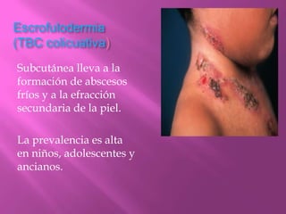 Escrofulodermia
(TBC colicuativa)
Subcutánea lleva a la
formación de abscesos
fríos y a la efracción
secundaria de la piel.

La prevalencia es alta
en niños, adolescentes y
ancianos.
 