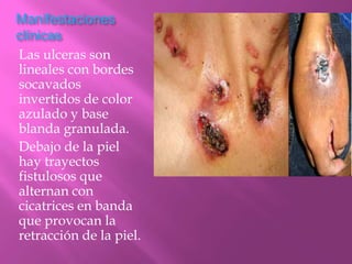 Manifestaciones
clínicas
Las ulceras son
lineales con bordes
socavados
invertidos de color
azulado y base
blanda granulada.
Debajo de la piel
hay trayectos
fistulosos que
alternan con
cicatrices en banda
que provocan la
retracción de la piel.
 