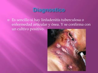    Es sencillo si hay linfadenitis tuberculosa o
    enfermedad articular y ósea. Y se confirma con
    un cultivo positivo.
 