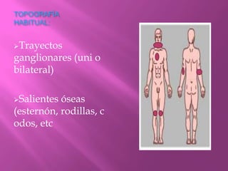 TOPOGRAFÍA
HABITUAL:


Trayectos
ganglionares (uni o
bilateral)

Salientes óseas
(esternón, rodillas, c
odos, etc
 
