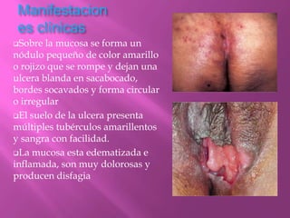 Manifestacion
 es clínicas
Sobre  la mucosa se forma un
nódulo pequeño de color amarillo
o rojizo que se rompe y dejan una
ulcera blanda en sacabocado,
bordes socavados y forma circular
o irregular
El suelo de la ulcera presenta
múltiples tubérculos amarillentos
y sangra con facilidad.
La mucosa esta edematizada e
inflamada, son muy dolorosas y
producen disfagia
 
