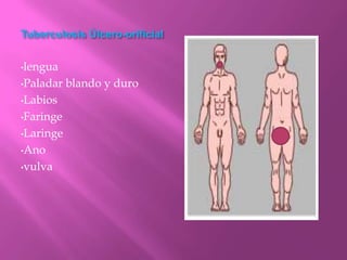 Tuberculosis Úlcero-orificial


•lengua

•Paladar   blando y duro
•Labios

•Faringe

•Laringe

•Ano

•vulva
 