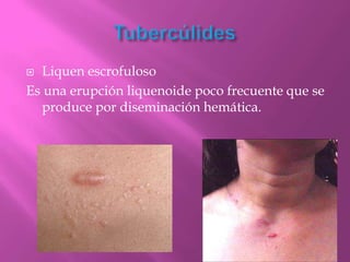  Liquen escrofuloso
Es una erupción liquenoide poco frecuente que se
  produce por diseminación hemática.
 