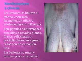 Manifestacione
s clínicas
Las lesiones se limitan al
tronco y son más
frecuentes en niños y
adolescentes con TB activa.
Son pápulas asintomáticas
amarillas o rosadas planas,
firmes, foliculares o
perifoliculares, en algunos
casos con descamación
fina.
Las lesiones se unen y
forman placas discoides.
 