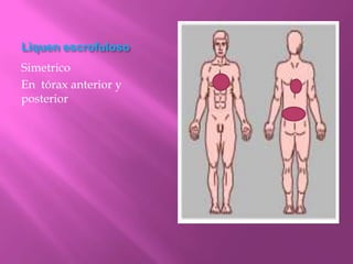 Liquen escrofuloso
Simetrico
En tórax anterior y
posterior
 