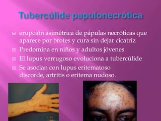    erupción asimétrica de pápulas necróticas que
    aparece por brotes y cura sin dejar cicatriz
   Predomina en niños y adultos jóvenes
   El lupus verrugoso evoluciona a tubercúlide
   Se asocian con lupus eritematoso
    discorde, artritis o eritema nudoso.
 