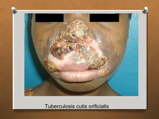 Tuberculosis cutis orificialis
 