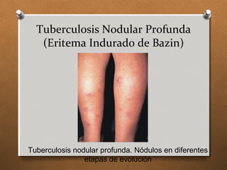 Tuberculosis Nodular Profunda
(Eritema Indurado de Bazin)
Tuberculosis nodular profunda. Nódulos en diferentes
etapas de evolución
 