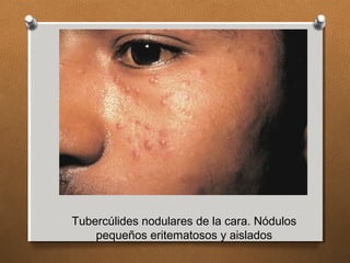 Tubercúlides nodulares de la cara. Nódulos
pequeños eritematosos y aislados
 