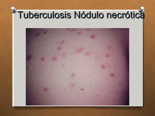 Tuberculosis Nódulo necróticaTuberculosis Nódulo necrótica
 